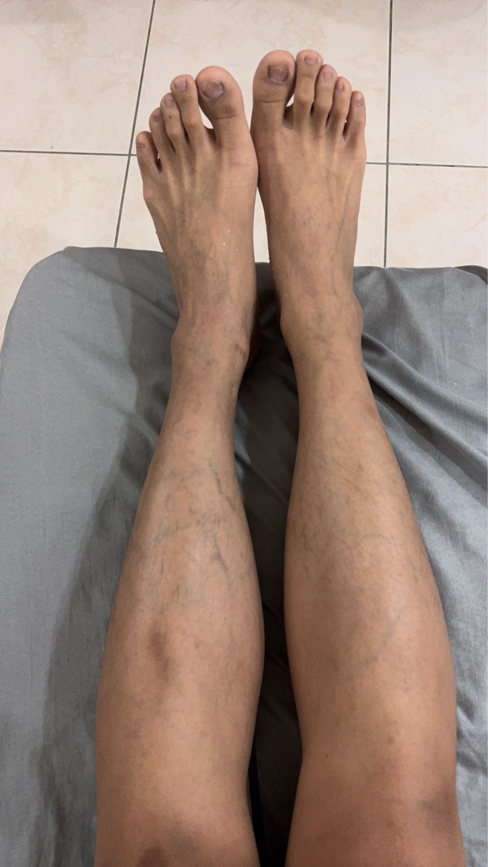 圖三治療後張先生接受半吻合周邊血液幹細胞移植後雙腿明顯改善終於讓困擾他數